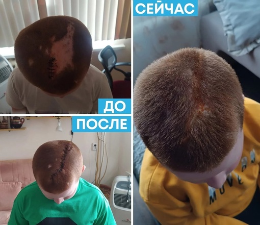 Медики из Челябинска восстановили волосы ребенку, потерянные из-за ожога головы.  Травму мальчик получил..