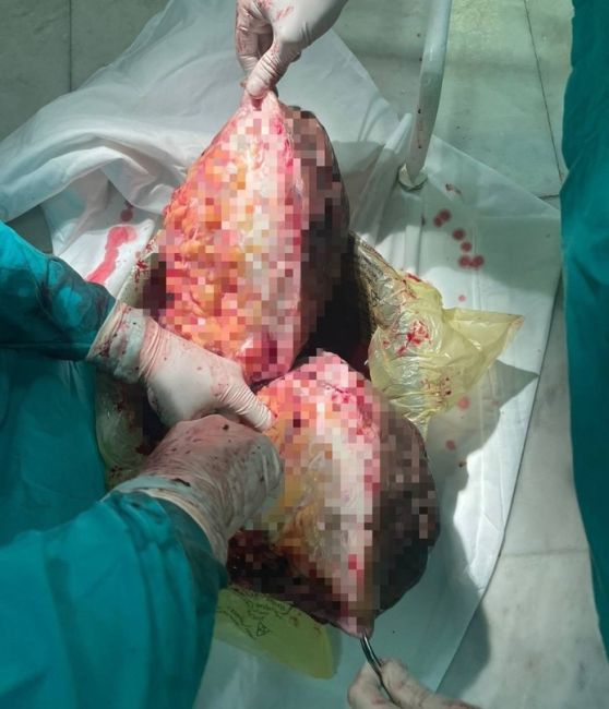 😱Врачи в Башкирии удалили мужчине 20-килограммовую опухоль 
Мужчину привезли в медучреждение с повышенной..