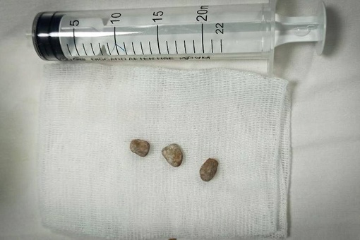Краснодарские хирурги провели пациентке уникальную операцию по удалению камней  Пациентка ранее..