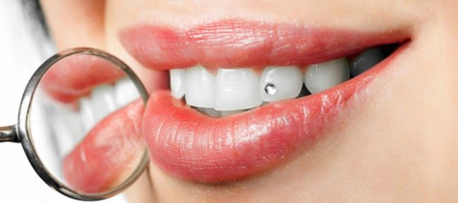 Реставрация зубов за 1 день винирами. 18+ 
В нашей стоматологии можно установить виниры на ваши зубы чтобы..