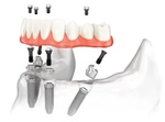 18+. Имплантация и протезирование зубов за 99 ₽/день с пожизненной гарантией на импланты! Бесплатное удаление..